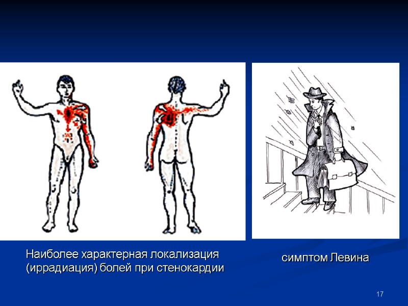 17 симптом Левина Наиболее характерная локализация  (иррадиация) болей при стенокардии